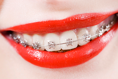 Brackets_Autoligables_JUCEP